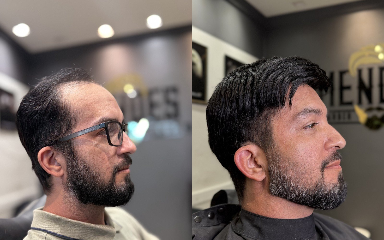Antes e depois prótese capilar masculina Colatina, vista de perfil 1