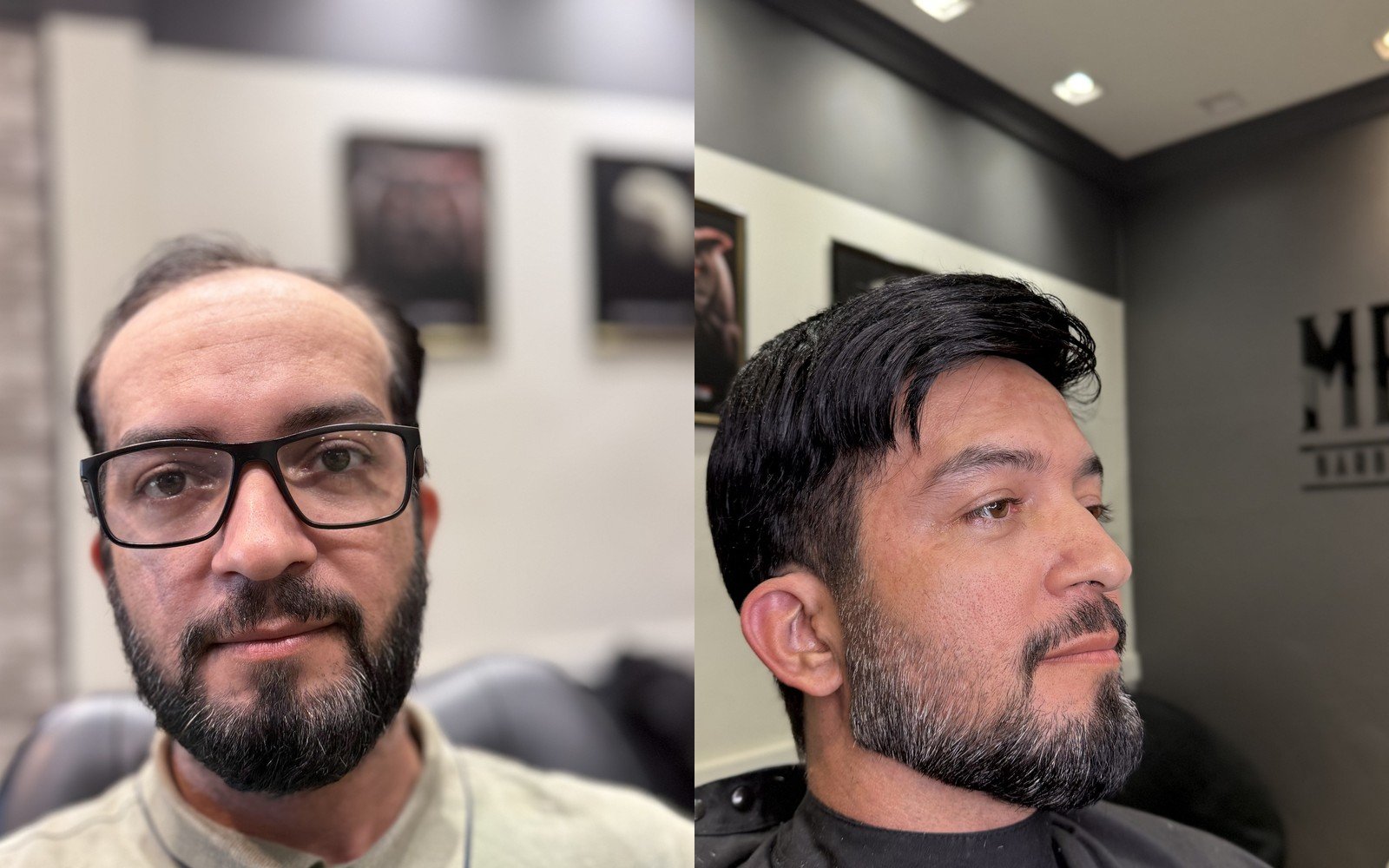 Antes e depois prótese capilar masculina Colatina 1